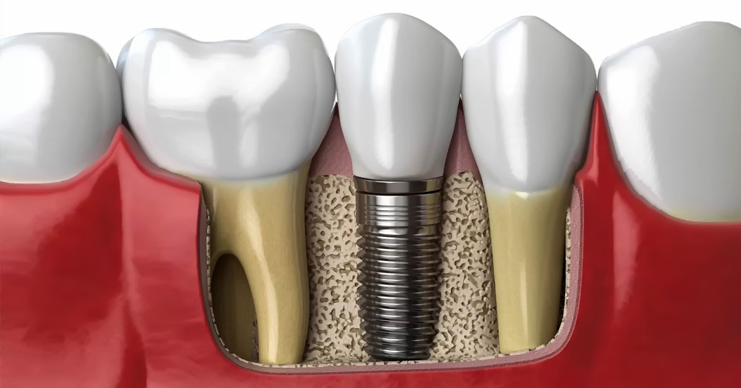Dental Implants