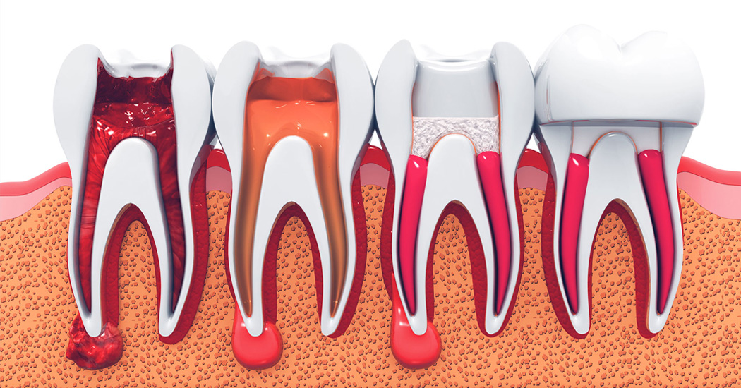Root Canal Treatment
