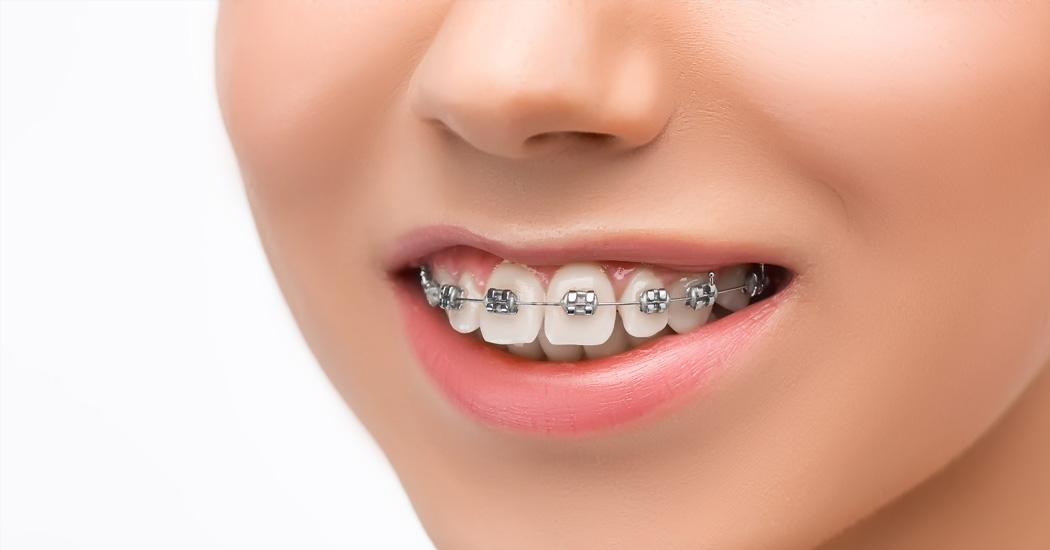 Teeth Braces & Clips