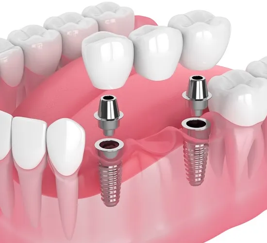 Crowns & Bridges in KPHB Kukatpally Hyderabad