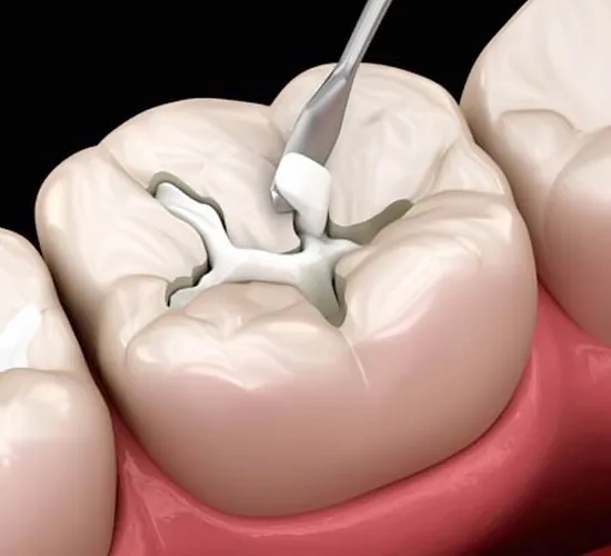 Dental Fillings in KPHB Kukatpally Hyderabad