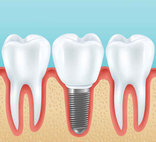 Dental Implants