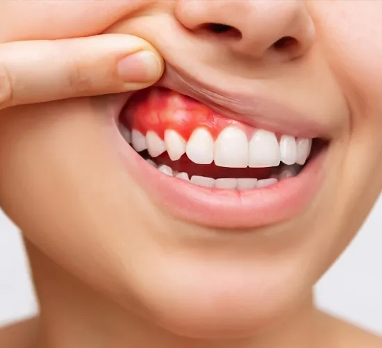 Gum Treatment in KPHB Kukatpally