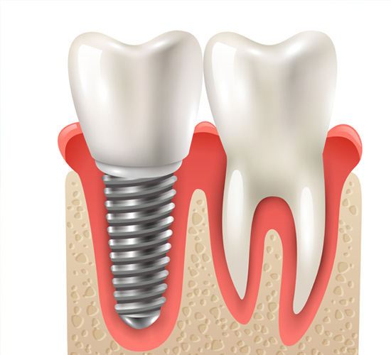 Dental Implants