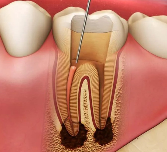 Root Canal Treatment