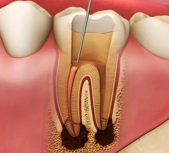 Root Canal Treatment in KPHB Kukatpally