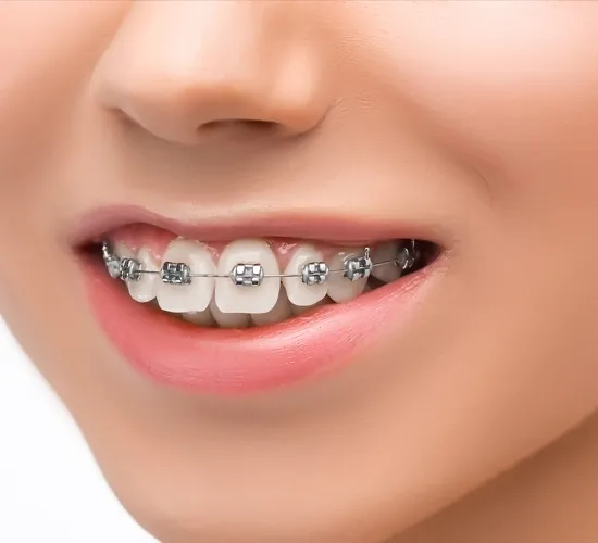 Teeth Braces & Clips in KPHB Kukatpally Hyderabad