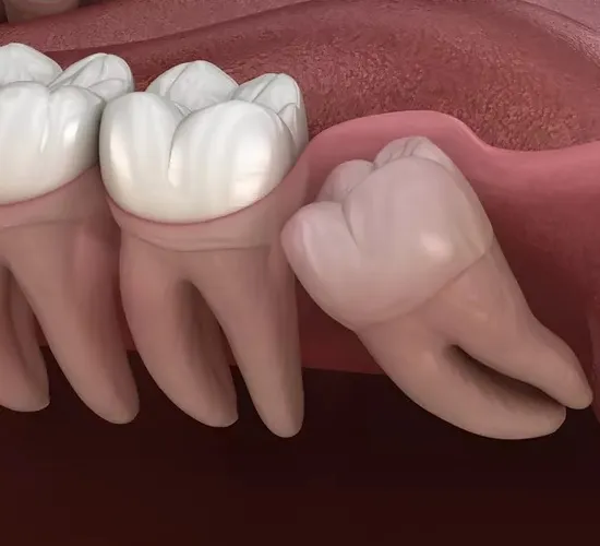 Wisdom Teeth Removal in KPHB Kukatpally Hyderabad